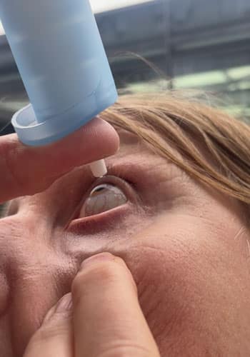 Eine Person gibt Augentropfen direkt ins rechte Auge, Nahaufnahme des Auges und der Pumpflasche.